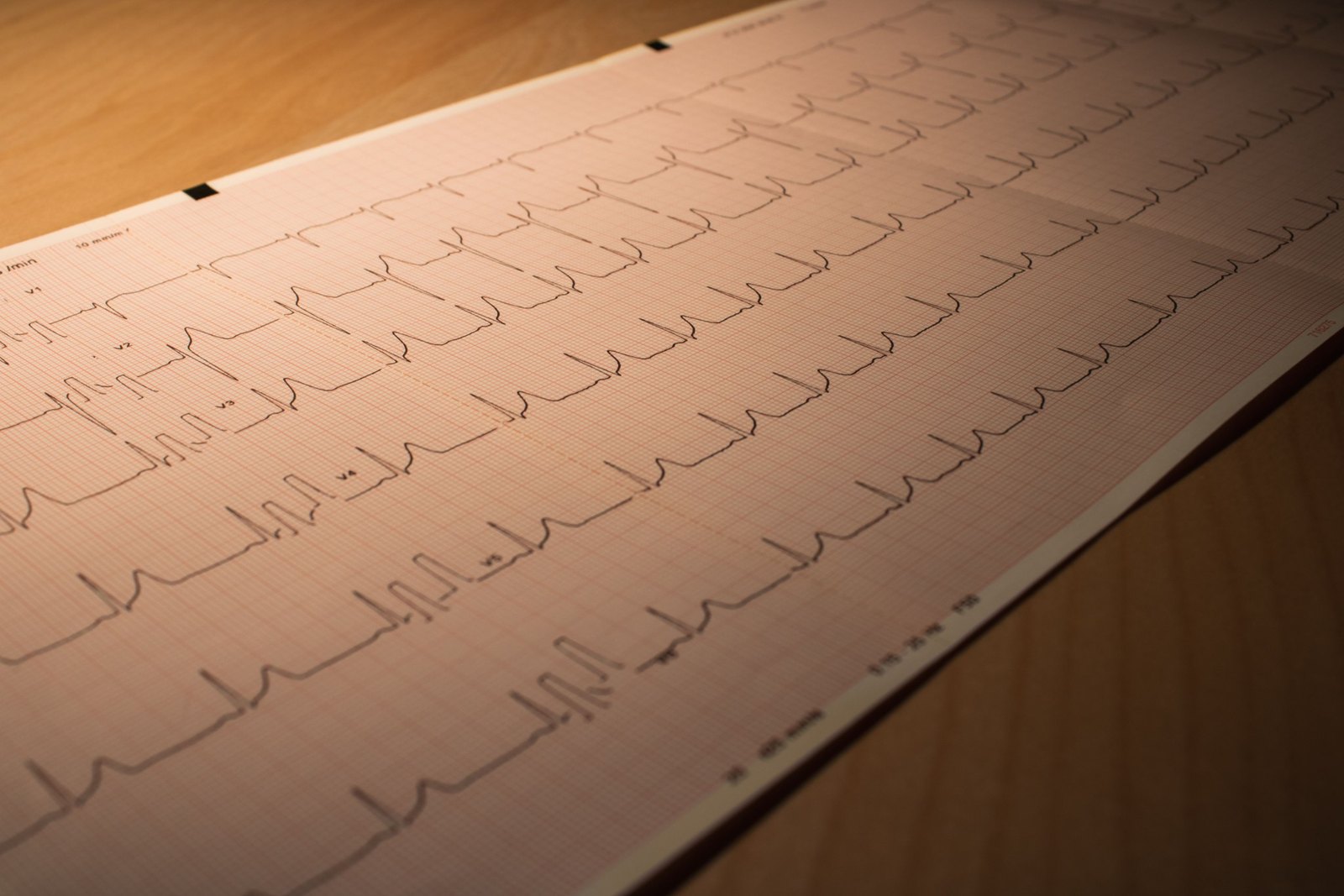 Twelve-lead ECG recording used to assess heart rhythm